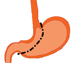 Stomach with line showing the portion removed (the right side) and portion staying (left side)